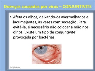 Doenças causadas por vírus – CONJUNTIVITE

  • Afeta os olhos, deixando-os avermelhados e
    lacrimejantes, às vezes com secreção. Para
    evitá-la, é necessário não colocar a mão nos
    olhos. Existe um tipo de conjuntivite
    provocada por bactérias.




  Profª. Lilian Larroca
 