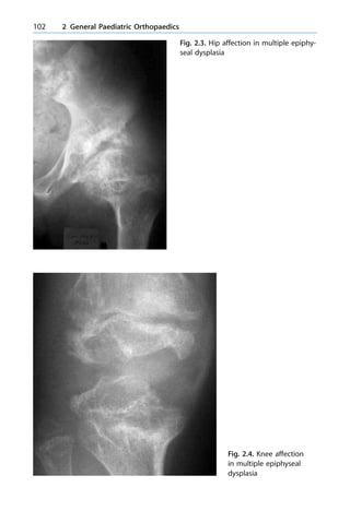 102 2 General Paediatric Orthopaedics
Fig. 2.3. Hip affection in multiple epiphy-
seal dysplasia
Fig. 2.4. Knee affection
in multiple epiphyseal
dysplasia
 