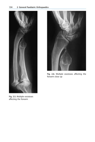 104 2 General Paediatric Orthopaedics
Fig. 2.5. Multiple exostoses
affecting the forearm
Fig. 2.6. Multiple exostoses affecting the
forearm close up
 