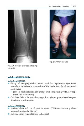 2.1.2 Cerebral Palsy
2.1.2.1 Definition
n Group of non-progressive, motor (mainly) impairment syndromes
secondary to lesions or anomalies of the brain from foetal to around
age 2 years
± [But its manifestations can change over time with growth, develop-
ment and maturation]
n Can have defects in sensation, cognition, seizure, gastrointestinal/gen-
itourinary problems, etc.
2.1.2.2 Aetiology
n Intrinsic abnormal central nervous system (CNS) structure (e.g. chro-
mosomal, metabolic disease)
n External insult (e.g. infection, ischaemia)
a 2.1 Generalised Disorders 105
Fig. 2.7. Multiple exostoses affecting
the ankle
Fig. 2.8. Ollier's disease
 