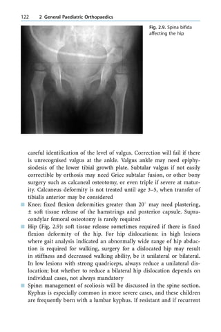 careful identification of the level of valgus. Correction will fail if there
is unrecognised valgus at the ankle. Valgus ankle may need epiphy-
siodesis of the lower tibial growth plate. Subtalar valgus if not easily
correctible by orthosis may need Grice subtalar fusion, or other bony
surgery such as calcaneal osteotomy, or even triple if severe at matur-
ity. Calcaneus deformity is not treated until age 3±5, when transfer of
tibialis anterior may be considered
n Knee: fixed flexion deformities greater than 208 may need plastering,
Ô soft tissue release of the hamstrings and posterior capsule. Supra-
condylar femoral osteotomy is rarely required
n Hip (Fig. 2.9): soft tissue release sometimes required if there is fixed
flexion deformity of the hip. For hip dislocations: in high lesions
where gait analysis indicated an abnormally wide range of hip abduc-
tion is required for walking, surgery for a dislocated hip may result
in stiffness and decreased walking ability, be it unilateral or bilateral.
In low lesions with strong quadriceps, always reduce a unilateral dis-
location; but whether to reduce a bilateral hip dislocation depends on
individual cases, not always mandatory
n Spine: management of scoliosis will be discussed in the spine section.
Kyphus is especially common in more severe cases, and these children
are frequently born with a lumbar kyphus. If resistant and if recurrent
122 2 General Paediatric Orthopaedics
Fig. 2.9. Spina bifida
affecting the hip
 