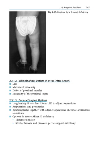 2.3.1.2 Biomechanical Defects in PFFD (After Aitken)
n LLD
n Malrotated extremity
n Defect of proximal muscles
n Instability of the proximal joints
2.3.1.3 General Surgical Options
n Lengthening: if less than 15 cm LLD Ô adjunct operations
n Amputations and prosthetics
n Rotationplasty: together with adjunct operations like knee arthrodesis
sometimes
n Options in severe Aitken D deficiency
± Iliofemoral fusion
± Steel's, Brown's and Ilizarov's pelvic-support osteotomy
a 2.3 Regional Problems 147
Fig. 2.13. Proximal focal femoral deficiency
 
