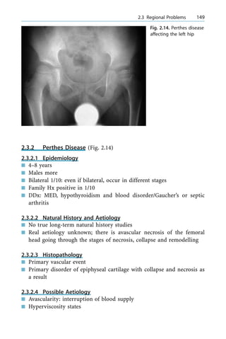 2.3.2 Perthes Disease (Fig. 2.14)
2.3.2.1 Epidemiology
n 4±8 years
n Males more
n Bilateral 1/10: even if bilateral, occur in different stages
n Family Hx positive in 1/10
n DDx: MED, hypothyroidism and blood disorder/Gaucher's or septic
arthritis
2.3.2.2 Natural History and Aetiology
n No true long-term natural history studies
n Real aetiology unknown; there is avascular necrosis of the femoral
head going through the stages of necrosis, collapse and remodelling
2.3.2.3 Histopathology
n Primary vascular event
n Primary disorder of epiphyseal cartilage with collapse and necrosis as
a result
2.3.2.4 Possible Aetiology
n Avascularity: interruption of blood supply
n Hyperviscosity states
a 2.3 Regional Problems 149
Fig. 2.14. Perthes disease
affecting the left hip
 
