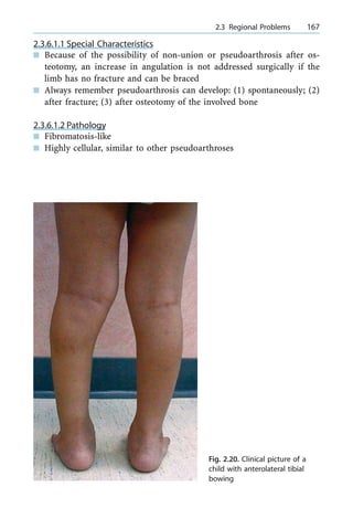 2.3.6.1.1 Special Characteristics
n Because of the possibility of non-union or pseudoarthrosis after os-
teotomy, an increase in angulation is not addressed surgically if the
limb has no fracture and can be braced
n Always remember pseudoarthrosis can develop: (1) spontaneously; (2)
after fracture; (3) after osteotomy of the involved bone
2.3.6.1.2 Pathology
n Fibromatosis-like
n Highly cellular, similar to other pseudoarthroses
a 2.3 Regional Problems 167
Fig. 2.20. Clinical picture of a
child with anterolateral tibial
bowing
 