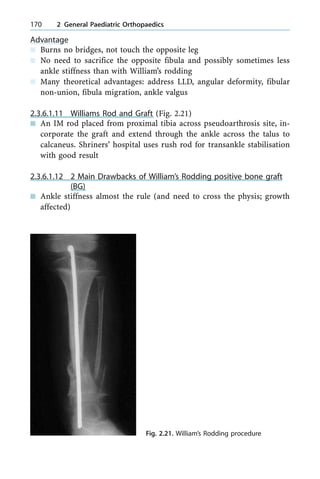 Advantage
n Burns no bridges, not touch the opposite leg
n No need to sacrifice the opposite fibula and possibly sometimes less
ankle stiffness than with William's rodding
n Many theoretical advantages: address LLD, angular deformity, fibular
non-union, fibula migration, ankle valgus
2.3.6.1.11 Williams Rod and Graft (Fig. 2.21)
n An IM rod placed from proximal tibia across pseudoarthrosis site, in-
corporate the graft and extend through the ankle across the talus to
calcaneus. Shriners' hospital uses rush rod for transankle stabilisation
with good result
2.3.6.1.12 2 Main Drawbacks of William's Rodding positive bone graft
(BG)
n Ankle stiffness almost the rule (and need to cross the physis; growth
affected)
170 2 General Paediatric Orthopaedics
Fig. 2.21. William's Rodding procedure
 