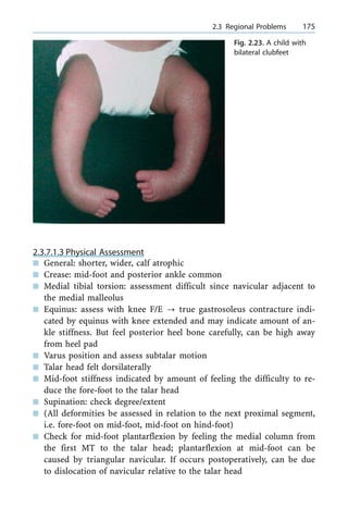 2.3.7.1.3 Physical Assessment
n General: shorter, wider, calf atrophic
n Crease: mid-foot and posterior ankle common
n Medial tibial torsion: assessment difficult since navicular adjacent to
the medial malleolus
n Equinus: assess with knee F/E ? true gastrosoleus contracture indi-
cated by equinus with knee extended and may indicate amount of an-
kle stiffness. But feel posterior heel bone carefully, can be high away
from heel pad
n Varus position and assess subtalar motion
n Talar head felt dorsilaterally
n Mid-foot stiffness indicated by amount of feeling the difficulty to re-
duce the fore-foot to the talar head
n Supination: check degree/extent
n (All deformities be assessed in relation to the next proximal segment,
i.e. fore-foot on mid-foot, mid-foot on hind-foot)
n Check for mid-foot plantarflexion by feeling the medial column from
the first MT to the talar head; plantarflexion at mid-foot can be
caused by triangular navicular. If occurs postoperatively, can be due
to dislocation of navicular relative to the talar head
a 2.3 Regional Problems 175
Fig. 2.23. A child with
bilateral clubfeet
 