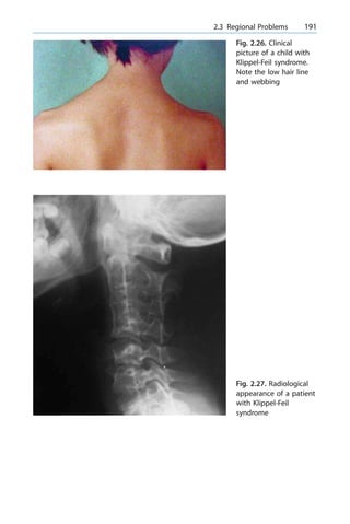 a 2.3 Regional Problems 191
Fig. 2.26. Clinical
picture of a child with
Klippel-Feil syndrome.
Note the low hair line
and webbing
Fig. 2.27. Radiological
appearance of a patient
with Klippel-Feil
syndrome
 