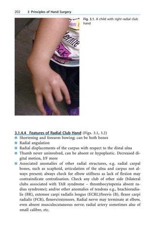 3.1.4.4 Features of Radial Club Hand (Figs. 3.1, 3.2)
n Shortening and forearm bowing; can be both bones
n Radial angulation
n Radial displacements of the carpus with respect to the distal ulna
n Thumb never uninvolved, can be absent or hypoplastic. Decreased di-
gital motion, I/F more
n Associated anomalies of other radial structures, e.g. radial carpal
bones, such as scaphoid, articulation of the ulna and carpus not al-
ways present; always check for elbow stiffness as lack of flexion may
contraindicate centralisation. Check any club of other side (bilateral
clubs associated with TAR syndrome ± thrombocytopenia absent ra-
dius syndrome); and/or other anomalies of tendons e.g., brachioradia-
lis (BR), extensor carpi radialis longus (ECRL)/brevis (B), flexor carpi
radialis (FCR), flexors/extensors. Radial nerve may terminate at elbow,
even absent musculocutaneous nerve; radial artery sometimes also of
small calibre, etc.
202 3 Principles of Hand Surgery
Fig. 3.1. A child with right radial club
hand
 