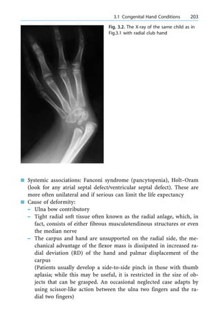 n Systemic associations: Fanconi syndrome (pancytopenia), Holt±Oram
(look for any atrial septal defect/ventricular septal defect). These are
more often unilateral and if serious can limit the life expectancy
n Cause of deformity:
± Ulna bow contributory
± Tight radial soft tissue often known as the radial anlage, which, in
fact, consists of either fibrous musculotendinous structures or even
the median nerve
± The carpus and hand are unsupported on the radial side, the me-
chanical advantage of the flexor mass is dissipated in increased ra-
dial deviation (RD) of the hand and palmar displacement of the
carpus
(Patients usually develop a side-to-side pinch in those with thumb
aplasia; while this may be useful, it is restricted in the size of ob-
jects that can be grasped. An occasional neglected case adapts by
using scissor-like action between the ulna two fingers and the ra-
dial two fingers)
a 3.1 Congenital Hand Conditions 203
Fig. 3.2. The X-ray of the same child as in
Fig.3.1 with radial club hand
 