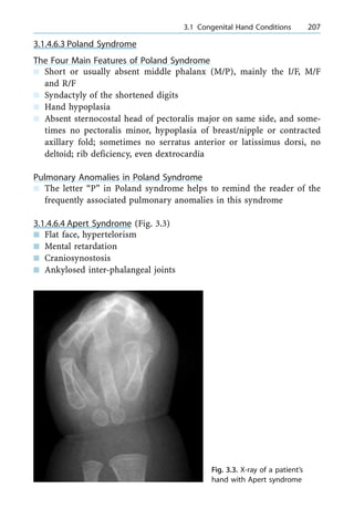 3.1.4.6.3 Poland Syndrome
The Four Main Features of Poland Syndrome
n Short or usually absent middle phalanx (M/P), mainly the I/F, M/F
and R/F
n Syndactyly of the shortened digits
n Hand hypoplasia
n Absent sternocostal head of pectoralis major on same side, and some-
times no pectoralis minor, hypoplasia of breast/nipple or contracted
axillary fold; sometimes no serratus anterior or latissimus dorsi, no
deltoid; rib deficiency, even dextrocardia
Pulmonary Anomalies in Poland Syndrome
n The letter ªPº in Poland syndrome helps to remind the reader of the
frequently associated pulmonary anomalies in this syndrome
3.1.4.6.4 Apert Syndrome (Fig. 3.3)
n Flat face, hypertelorism
n Mental retardation
n Craniosynostosis
n Ankylosed inter-phalangeal joints
a 3.1 Congenital Hand Conditions 207
Fig. 3.3. X-ray of a patient's
hand with Apert syndrome
 