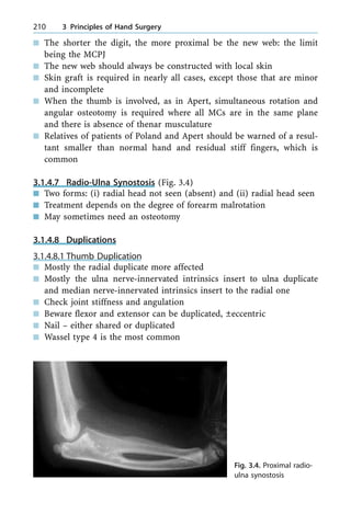 n The shorter the digit, the more proximal be the new web: the limit
being the MCPJ
n The new web should always be constructed with local skin
n Skin graft is required in nearly all cases, except those that are minor
and incomplete
n When the thumb is involved, as in Apert, simultaneous rotation and
angular osteotomy is required where all MCs are in the same plane
and there is absence of thenar musculature
n Relatives of patients of Poland and Apert should be warned of a resul-
tant smaller than normal hand and residual stiff fingers, which is
common
3.1.4.7 Radio-Ulna Synostosis (Fig. 3.4)
n Two forms: (i) radial head not seen (absent) and (ii) radial head seen
n Treatment depends on the degree of forearm malrotation
n May sometimes need an osteotomy
3.1.4.8 Duplications
3.1.4.8.1 Thumb Duplication
n Mostly the radial duplicate more affected
n Mostly the ulna nerve-innervated intrinsics insert to ulna duplicate
and median nerve-innervated intrinsics insert to the radial one
n Check joint stiffness and angulation
n Beware flexor and extensor can be duplicated, Ôeccentric
n Nail ± either shared or duplicated
n Wassel type 4 is the most common
210 3 Principles of Hand Surgery
Fig. 3.4. Proximal radio-
ulna synostosis
 