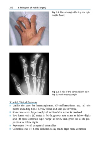 3.1.4.9.1 Clinical Features
n Unlike the case for haemangiomas, AV-malformations, etc., all ele-
ments including bone, nerve, vessel and skin are involved
n Sometimes even hypertrophy of median/ulna nerve is involved
n Two forms exist: (1) noted at birth, growth rate same as fellow digits
and (2) more common type, `large' at birth, then grow out of its pro-
portion to fellow digits
n Represents 1% all congenital anomalies
n Common site: I/F. Some authorities say multi-digit more common
212 3 Principles of Hand Surgery
Fig. 3.5. Macrodactyly affecting the right
middle finger
Fig. 3.6. X-ray of the same patient as in
Fig. 3.5 with macrodactyly
 