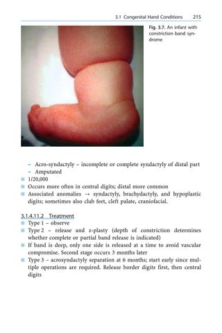 ± Acro-syndactyly ± incomplete or complete syndactyly of distal part
± Amputated
n 1/20,000
n Occurs more often in central digits; distal more common
n Associated anomalies ? syndactyly, brachydactyly, and hypoplastic
digits; sometimes also club feet, cleft palate, craniofacial.
3.1.4.11.2 Treatment
n Type 1 ± observe
n Type 2 ± release and z-plasty (depth of constriction determines
whether complete or partial band release is indicated)
n If band is deep, only one side is released at a time to avoid vascular
compromise. Second stage occurs 3 months later
n Type 3 ± acrosyndactyly separation at 6 months; start early since mul-
tiple operations are required. Release border digits first, then central
digits
a 3.1 Congenital Hand Conditions 215
Fig. 3.7. An infant with
constriction band syn-
drome
 