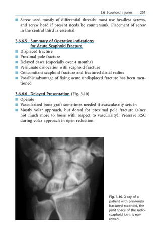 n Screw used mostly of differential threads; most use headless screws,
and screw head if present needs be countersunk. Placement of screw
in the central third is essential
3.6.6.5 Summary of Operative Indications
for Acute Scaphoid Fracture
n Displaced fracture
n Proximal pole fracture
n Delayed cases (especially over 4 months)
n Perilunate dislocation with scaphoid fracture
n Concomitant scaphoid fracture and fractured distal radius
n Possible advantage of fixing acute undisplaced fracture has been men-
tioned
3.6.6.6 Delayed Presentation (Fig. 3.10)
n Operate
n Vascularised bone graft sometimes needed if avasculasrity sets in
n Mostly volar approach, but dorsal for proximal pole fracture (since
not much more to loose with respect to vascularity). Preserve RSC
during volar approach in open reduction
a 3.6 Scaphoid Injuries 251
Fig. 3.10. X-ray of a
patient with previously
fractured scaphoid, the
joint space of the radio-
scaphoid joint is nar-
rowed
 