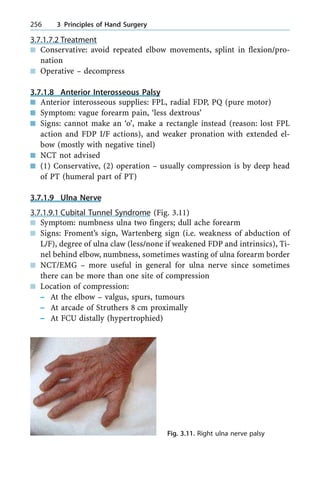 3.7.1.7.2 Treatment
n Conservative: avoid repeated elbow movements, splint in flexion/pro-
nation
n Operative ± decompress
3.7.1.8 Anterior Interosseous Palsy
n Anterior interosseous supplies: FPL, radial FDP, PQ (pure motor)
n Symptom: vague forearm pain, `less dextrous'
n Signs: cannot make an `o', make a rectangle instead (reason: lost FPL
action and FDP I/F actions), and weaker pronation with extended el-
bow (mostly with negative tinel)
n NCT not advised
n (1) Conservative, (2) operation ± usually compression is by deep head
of PT (humeral part of PT)
3.7.1.9 Ulna Nerve
3.7.1.9.1 Cubital Tunnel Syndrome (Fig. 3.11)
n Symptom: numbness ulna two fingers; dull ache forearm
n Signs: Froment's sign, Wartenberg sign (i.e. weakness of abduction of
L/F), degree of ulna claw (less/none if weakened FDP and intrinsics), Ti-
nel behind elbow, numbness, sometimes wasting of ulna forearm border
n NCT/EMG ± more useful in general for ulna nerve since sometimes
there can be more than one site of compression
n Location of compression:
± At the elbow ± valgus, spurs, tumours
± At arcade of Struthers 8 cm proximally
± At FCU distally (hypertrophied)
256 3 Principles of Hand Surgery
Fig. 3.11. Right ulna nerve palsy
 