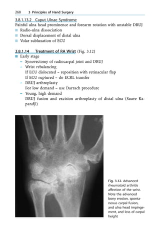 3.8.1.13.2 Caput Ulnae Syndrome
Painful ulna head prominence and forearm rotation with unstable DRUJ
n Radio-ulna dissociation
n Dorsal displacement of distal ulna
n Volar subluxation of ECU
3.8.1.14 Treatment of RA Wrist (Fig. 3.12)
n Early stage
± Synovectomy of radiocarpal joint and DRUJ
± Wrist rebalancing
If ECU dislocated ± reposition with retinacular flap
If ECU ruptured ± do ECRL transfer
± DRUJ arthroplasty
For low demand ± use Darrach procedure
± Young, high demand
DRUJ fusion and excision arthroplasty of distal ulna (Sauve Ka-
pandji)
268 3 Principles of Hand Surgery
Fig. 3.12. Advanced
rheumatoid arthritis
affection of the wrist.
Note the advanced
bony erosion, sponta-
neous carpal fusion,
and ulna head impinge-
ment, and loss of carpal
height
 