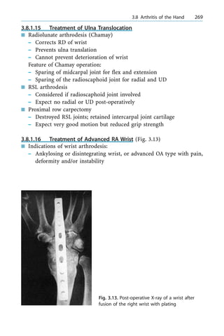 3.8.1.15 Treatment of Ulna Translocation
n Radiolunate arthrodesis (Chamay)
± Corrects RD of wrist
± Prevents ulna translation
± Cannot prevent deterioration of wrist
Feature of Chamay operation:
± Sparing of midcarpal joint for flex and extension
± Sparing of the radioscaphoid joint for radial and UD
n RSL arthrodesis
± Considered if radioscaphoid joint involved
± Expect no radial or UD post-operatively
n Proximal row carpectomy
± Destroyed RSL joints; retained intercarpal joint cartilage
± Expect very good motion but reduced grip strength
3.8.1.16 Treatment of Advanced RA Wrist (Fig. 3.13)
n Indications of wrist arthrodesis:
± Ankylosing or disintegrating wrist, or advanced OA type with pain,
deformity and/or instability
a 3.8 Arthritis of the Hand 269
Fig. 3.13. Post-operative X-ray of a wrist after
fusion of the right wrist with plating
 