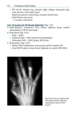 ± PIP 30±408 extensor lag, intrinsic tight, oblique retinacular liga-
ment shorten, volar lateral band
Repair/reconstruct central-slip; centralise lateral band
± Fixed flexion and severe
? Consider arthrodesis
3.8.1.19 Surgery for RA Thumb Deformity (Fig. 3.14)
n Game-keeper's: reconstruct UCL, release adductor fascia (and/or
plasty/fusion if MCPJ destroyed)
n Swan-Neck (Fig. 3.15):
± Early ± splint
± Subluxed CMC± CMCJ fascial hemiarthroplasty
± Dislocated CMC ± CMCJ plasty, MCPJ fuse
n Boutonniere (Fig. 3.16):
± Mobile MCPJ subluxation: synovectomy MCPJ, transfer EPL
± Fixed MCPJ: plasty versus fusion (depends on nearby IPJ/CMCJ)
272 3 Principles of Hand Surgery
Fig. 3.14. X-ray of a patient with
rheumatoid arthritis affecting
especially the bones of the
thumb
 