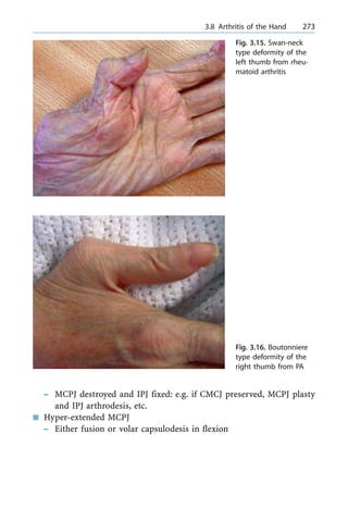 ± MCPJ destroyed and IPJ fixed: e.g. if CMCJ preserved, MCPJ plasty
and IPJ arthrodesis, etc.
n Hyper-extended MCPJ
± Either fusion or volar capsulodesis in flexion
a 3.8 Arthritis of the Hand 273
Fig. 3.15. Swan-neck
type deformity of the
left thumb from rheu-
matoid arthritis
Fig. 3.16. Boutonniere
type deformity of the
right thumb from PA
 