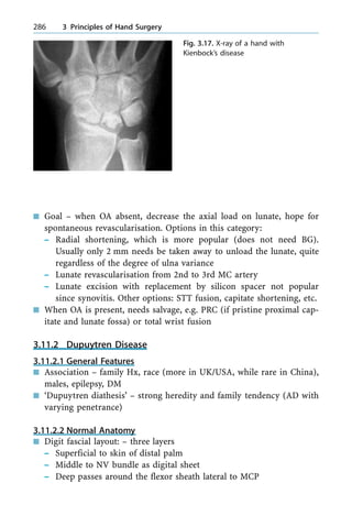 n Goal ± when OA absent, decrease the axial load on lunate, hope for
spontaneous revascularisation. Options in this category:
± Radial shortening, which is more popular (does not need BG).
Usually only 2 mm needs be taken away to unload the lunate, quite
regardless of the degree of ulna variance
± Lunate revascularisation from 2nd to 3rd MC artery
± Lunate excision with replacement by silicon spacer not popular
since synovitis. Other options: STT fusion, capitate shortening, etc.
n When OA is present, needs salvage, e.g. PRC (if pristine proximal cap-
itate and lunate fossa) or total wrist fusion
3.11.2 Dupuytren Disease
3.11.2.1 General Features
n Association ± family Hx, race (more in UK/USA, while rare in China),
males, epilepsy, DM
n `Dupuytren diathesis' ± strong heredity and family tendency (AD with
varying penetrance)
3.11.2.2 Normal Anatomy
n Digit fascial layout: ± three layers
± Superficial to skin of distal palm
± Middle to NV bundle as digital sheet
± Deep passes around the flexor sheath lateral to MCP
286 3 Principles of Hand Surgery
Fig. 3.17. X-ray of a hand with
Kienbock's disease
 