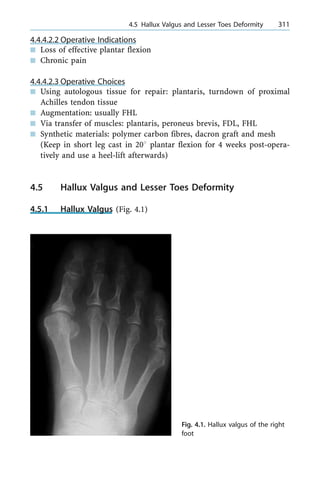 4.4.4.2.2 Operative Indications
n Loss of effective plantar flexion
n Chronic pain
4.4.4.2.3 Operative Choices
n Using autologous tissue for repair: plantaris, turndown of proximal
Achilles tendon tissue
n Augmentation: usually FHL
n Via transfer of muscles: plantaris, peroneus brevis, FDL, FHL
n Synthetic materials: polymer carbon fibres, dacron graft and mesh
(Keep in short leg cast in 208 plantar flexion for 4 weeks post-opera-
tively and use a heel-lift afterwards)
4.5 Hallux Valgus and Lesser Toes Deformity
4.5.1 Hallux Valgus (Fig. 4.1)
a 4.5 Hallux Valgus and Lesser Toes Deformity 311
Fig. 4.1. Hallux valgus of the right
foot
 