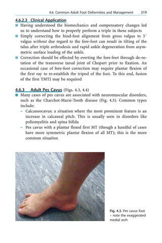 4.6.2.3 Clinical Application
n Having understood the biomechanics and compensatory changes led
us to understand how to properly perform a triple in these subjects
n Simply correcting the hind-foot alignment from gross valgus to 58
valgus without due regard to the fore-foot can result in tilting of the
talus after triple arthrodesis and rapid ankle degeneration from asym-
metric surface loading of the ankle.
n Correction should be effected by everting the fore-foot through de-ro-
tation of the transverse tarsal joint of Chopart prior to fixation. An
occasional case of fore-foot correction may require plantar flexion of
the first ray to re-establish the tripod of the foot. To this end, fusion
of the first TMTJ may be required
4.6.3 Adult Pes Cavus (Figs. 4.3, 4.4)
n Many cases of pes cavus are associated with neuromuscular disorders,
such as the Charchot-Marie-Tooth disease (Fig. 4.5). Common types
include:
± Calcaneocavus: a situation where the most prominent feature is an
increase in calcaneal pitch. This is usually seen in disorders like
poliomyelitis and spina bifida
± Pes cavus with a plantar flexed first MT (though a handful of cases
have more symmetric plantar flexion of all MT); this is the more
common situation
a 4.6 Common Adult Foot Deformities and Management 319
Fig. 4.3. Pes cavus foot
± note the exaggerated
medial arch
 