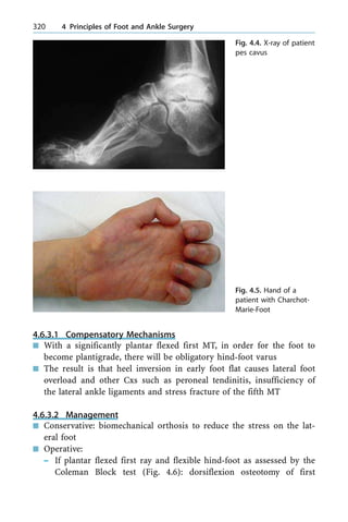 4.6.3.1 Compensatory Mechanisms
n With a significantly plantar flexed first MT, in order for the foot to
become plantigrade, there will be obligatory hind-foot varus
n The result is that heel inversion in early foot flat causes lateral foot
overload and other Cxs such as peroneal tendinitis, insufficiency of
the lateral ankle ligaments and stress fracture of the fifth MT
4.6.3.2 Management
n Conservative: biomechanical orthosis to reduce the stress on the lat-
eral foot
n Operative:
± If plantar flexed first ray and flexible hind-foot as assessed by the
Coleman Block test (Fig. 4.6): dorsiflexion osteotomy of first
320 4 Principles of Foot and Ankle Surgery
Fig. 4.4. X-ray of patient
pes cavus
Fig. 4.5. Hand of a
patient with Charchot-
Marie-Foot
 