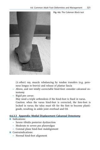 (Ô other) ray, muscle rebalancing by tendon transfers (e.g. pero-
neus longus to brevis) and release of plantar fascia
± Above, and not totally correctable hind-foot: consider calcaneal os-
teotomy
± Rigid pes cavus:
May need a triple arthrodesis if the hind-foot is fixed in varus.
Caution: when the varus hind-foot is corrected, the fore-foot is
locked in varus; the talus must tilt for the foot to become planti-
grade, resulting in ankle joint overload and OA
4.6.3.3 Appendix: Medial Displacement Calcaneal Osteotomy
n Indications:
± Severe tibialis posterior dysfunction
± Moderate to severe pes planovalgus
± Coronal plane hind-foot malalignment
n Contraindications:
± Normal hind-foot alignment
a 4.6 Common Adult Foot Deformities and Management 321
Fig. 4.6. The Coleman Block test
 