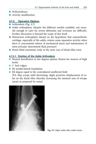 n Orthosis/brace
n Activity modification
4.7.3 Operative Options
n Arthrodesis (Fig. 4.7)
n Ankle arthroplasty (despite the different models available, not versa-
tile enough to cater for severe deformity and revisions are difficult).
Further discussion is beyond the scope of this book
n Distraction arthroplasty (based on the hypothesis that osteoarthritic
cartilage, especially of the ankle, retains some reparative activity when
there is concomitant release of mechanical stress and maintenance of
intra-articular intermittent fluid pressure)
n Distal tibial osteotomy (only in the rarer case of distal tibia vara)
4.7.3.1 Position of the Ankle Arthrodesis
n Neutral dorsiflexion (a few degrees plantar flexion for wearers of high
heels)
n 58 heel valgus
n No medial-lateral translation
n ER degree equal to the contralateral unaffected limb
(P.S. May accept mild shortening, slight posterior displacement of ta-
lus on the distal tibia (thereby increasing the moment arm of triceps
surae) as proposed by some)
a 4.7 Degenerative Arthritis of the Foot and Ankle 323
Fig. 4.7. Right ankle after ankle fusion
 