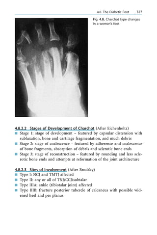 4.8.2.2 Stages of Development of Charchot (After Eichenholtz)
n Stage 1: stage of development ± featured by capsular distension with
subluxation, bone and cartilage fragmentation, and much debris
n Stage 2: stage of coalescence ± featured by adherence and coalescence
of bone fragments, absorption of debris and sclerotic bone ends
n Stage 3: stage of reconstruction ± featured by rounding and less scle-
rotic bone ends and attempts at reformation of the joint architecture
4.8.2.3 Sites of Involvement (After Brodsky)
n Type I: NCJ and TMTJ affected
n Type II: any or all of TNJ/CCJ/subtalar
n Type IIIA: ankle (tibiotalar joint) affected
n Type IIIB: fracture posterior tubercle of calcaneus with possible wid-
ened heel and pes planus
a 4.8 The Diabetic Foot 327
Fig. 4.8. Charchot type changes
in a woman's foot
 