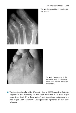 n The fore-foot is splayed in RA, partly due to MTPJ synovitis that pre-
disposes to HV. However, so does foot pronation 28 to heel valgus
(sometimes itself 28 to knee valgus) and sometimes metatarsus pri-
mus valgus (IMA increased). Lax capsule and ligaments are also con-
tributory
a 4.9 Rheumatoid Foot 333
Fig. 4.9. Rheumatoid arthritis affecting
the left foot
Fig. 4.10. Pressure sore at the
metatarsal head in a Rheuma-
toid arthritic patient with fore-
foot disease
 