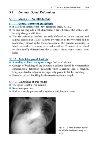 5.1 Common Spinal Deformities
5.1.1 Scoliosis ± An Introduction
5.1.1.1 General Comment on Scoliosis
n It is a three-dimensional (3D) deformity (Figs. 5.1, 5.2)
n To this, we may add a 4th dimension. This is because the scoliotic de-
formity changes with time
n The 3D deformity involves not only deformities in the coronal and
sagittal planes, but is also featured by rotation of the vertebral bodies
(commonly picked up by the appearance of the pedicles according to
Moe's method of assessing vertebral rotation). Presence of vertebral
rotation readily differentiates the structural from non-structural sco-
liosis
5.1.1.2 Basic Principle of Scoliosis
n According to Euler, the spine is regarded as a `column'
n Concept of buckling of the column: a column loaded in compression
experiences a deflection instability when a critical load is reached.
Long and slender columns are especially prone to fail by buckling
n Formula: critical buckling load=constant/column length
5.1.1.3 Limitations of this model
n The spine is not a true column
n Non-homogeneous
n Buckles already present: with kyphotic and lordotic areas
a 5.1 Common Spinal Deformities 349
Fig. 5.1. Marked thoracic scolio-
sis with limited pulmonary re-
serve
 
