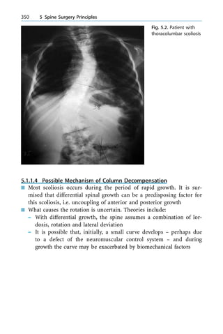 5.1.1.4 Possible Mechanism of Column Decompensation
n Most scoliosis occurs during the period of rapid growth. It is sur-
mised that differential spinal growth can be a predisposing factor for
this scoliosis, i.e. uncoupling of anterior and posterior growth
n What causes the rotation is uncertain. Theories include:
± With differential growth, the spine assumes a combination of lor-
dosis, rotation and lateral deviation
± It is possible that, initially, a small curve develops ± perhaps due
to a defect of the neuromuscular control system ± and during
growth the curve may be exacerbated by biomechanical factors
350 5 Spine Surgery Principles
Fig. 5.2. Patient with
thoracolumbar scoliosis
 