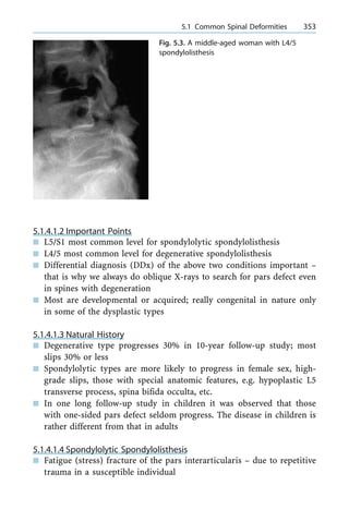 5.1.4.1.2 Important Points
n L5/S1 most common level for spondylolytic spondylolisthesis
n L4/5 most common level for degenerative spondylolisthesis
n Differential diagnosis (DDx) of the above two conditions important ±
that is why we always do oblique X-rays to search for pars defect even
in spines with degeneration
n Most are developmental or acquired; really congenital in nature only
in some of the dysplastic types
5.1.4.1.3 Natural History
n Degenerative type progresses 30% in 10-year follow-up study; most
slips 30% or less
n Spondylolytic types are more likely to progress in female sex, high-
grade slips, those with special anatomic features, e.g. hypoplastic L5
transverse process, spina bifida occulta, etc.
n In one long follow-up study in children it was observed that those
with one-sided pars defect seldom progress. The disease in children is
rather different from that in adults
5.1.4.1.4 Spondylolytic Spondylolisthesis
n Fatigue (stress) fracture of the pars interarticularis ± due to repetitive
trauma in a susceptible individual
a 5.1 Common Spinal Deformities 353
Fig. 5.3. A middle-aged woman with L4/5
spondylolisthesis
 