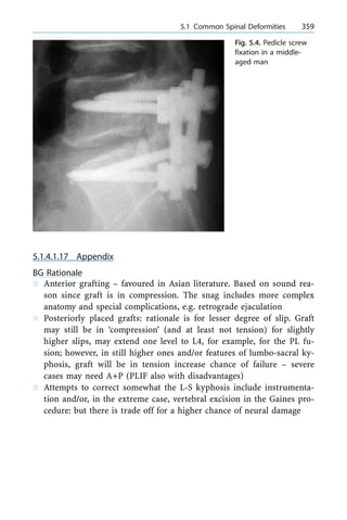 5.1.4.1.17 Appendix
BG Rationale
n Anterior grafting ± favoured in Asian literature. Based on sound rea-
son since graft is in compression. The snag includes more complex
anatomy and special complications, e.g. retrograde ejaculation
n Posteriorly placed grafts: rationale is for lesser degree of slip. Graft
may still be in `compression' (and at least not tension) for slightly
higher slips, may extend one level to L4, for example, for the PL fu-
sion; however, in still higher ones and/or features of lumbo-sacral ky-
phosis, graft will be in tension increase chance of failure ± severe
cases may need A+P (PLIF also with disadvantages)
n Attempts to correct somewhat the L-S kyphosis include instrumenta-
tion and/or, in the extreme case, vertebral excision in the Gaines pro-
cedure: but there is trade off for a higher chance of neural damage
a 5.1 Common Spinal Deformities 359
Fig. 5.4. Pedicle screw
fixation in a middle-
aged man
 