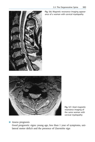 n Assess prognosis
Good prognostic signs: young age, less than 1 year of symptoms, uni-
lateral motor deficit and the presence of Lhermitte sign
a 5.3 The Degenerative Spine 383
Fig. 5.6. Magnetic resonance imaging appear-
ance of a woman with cervical myelopathy
Fig. 5.7. Axial magnetic
resonance imaging of
the same woman with
cervical myelopathy
 