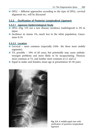 n OPLL ± different approaches according to the type of OPLL, cervical
alignment etc., will be discussed
5.3.2 Ossification of Posterior Longitudinal Ligament
5.3.2.1 Japanese Epidermiological Study
n OPLL (Fig. 5.9) not a new disease: incidence (radiological) is 2% in
Japan
n Incidence in Asians 1%, much less in the white population, Cauca-
sians 0.1%
5.3.2.2 Location
n Cervical ± most common (especially C456± the three most mobile
segments)
n T/L possible ± 10% of all cases, but potentially may cause ambula-
tory/gait problems and more likely to be incapacitating. Thoracic
most common at T5, and lumbar most common at L1 and L2
n Equal in males and females; mean age at presentation 45±50 years
a 5.3 The Degenerative Spine 385
Fig. 5.9. A middle-aged man with
ossification of posterior longitudinal
ligament
 