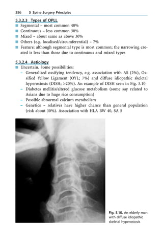 5.3.2.3 Types of OPLL
n Segmental ± most common 40%
n Continuous ± less common 30%
n Mixed ± about same as above 30%
n Others (e.g. localised/circumferential) ± 7%
n Feature: although segmental type is most common; the narrowing cre-
ated is less than those due to continuous and mixed types
5.3.2.4 Aetiology
n Uncertain. Some possibilities:
± Generalised ossifying tendency, e.g. association with AS (2%), Os-
sified Yellow Ligament (OYL; 7%) and diffuse idiopathic skeletal
hyperostosis (DISH; >20%). An example of DISH seen in Fig. 5.10
± Diabetes mellitis/altered glucose metabolism (some say related to
Asians due to huge rice consumption)
± Possible abnormal calcium metabolism
± Genetics ± relatives have higher chance than general population
(risk about 30%). Association with HLA BW 40, SA 5
386 5 Spine Surgery Principles
Fig. 5.10. An elderly man
with diffuse idiopathic
skeletal hyperostosis
 