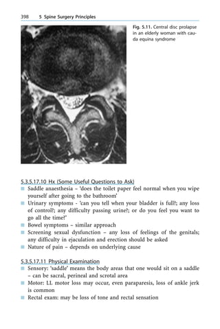 5.3.5.17.10 Hx (Some Useful Questions to Ask)
n Saddle anaesthesia ± `does the toilet paper feel normal when you wipe
yourself after going to the bathroom'
n Urinary symptoms - `can you tell when your bladder is full?; any loss
of control?; any difficulty passing urine?; or do you feel you want to
go all the time?'
n Bowel symptoms ± similar approach
n Screening sexual dysfunction ± any loss of feelings of the genitals;
any difficulty in ejaculation and erection should be asked
n Nature of pain ± depends on underlying cause
5.3.5.17.11 Physical Examination
n Sensory: `saddle' means the body areas that one would sit on a saddle
± can be sacral, perineal and scrotal area
n Motor: LL motor loss may occur, even paraparesis, loss of ankle jerk
is common
n Rectal exam: may be loss of tone and rectal sensation
398 5 Spine Surgery Principles
Fig. 5.11. Central disc prolapse
in an elderly woman with cau-
da equina syndrome
 