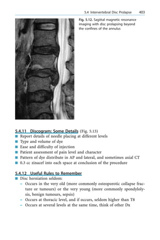 5.4.11 Discogram: Some Details (Fig. 5.13)
n Report details of needle placing at different levels
n Type and volume of dye
n Ease and difficulty of injection
n Patient assessment of pain level and character
n Pattern of dye distribute in AP and lateral, and sometimes axial CT
n 0.3 cc zinacef into each space at conclusion of the procedure
5.4.12 Useful Rules to Remember
n Disc herniation seldom:
± Occurs in the very old (more commonly osteoporotic collapse frac-
ture or tumours) or the very young (more commonly spondyloly-
sis, benign tumours, sepsis)
± Occurs at thoracic level, and if occurs, seldom higher than T8
± Occurs at several levels at the same time, think of other Dx
a 5.4 Intervertebral Disc Prolapse 403
Fig. 5.12. Sagittal magnetic resonance
imaging with disc prolapsing beyond
the confines of the annulus
 
