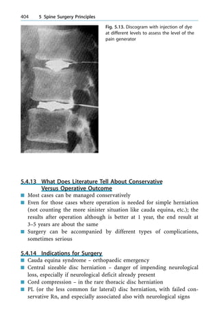 5.4.13 What Does Literature Tell About Conservative
Versus Operative Outcome
n Most cases can be managed conservatively
n Even for those cases where operation is needed for simple herniation
(not counting the more sinister situation like cauda equina, etc.); the
results after operation although is better at 1 year, the end result at
3±5 years are about the same
n Surgery can be accompanied by different types of complications,
sometimes serious
5.4.14 Indications for Surgery
n Cauda equina syndrome ± orthopaedic emergency
n Central sizeable disc herniation ± danger of impending neurological
loss, especially if neurological deficit already present
n Cord compression ± in the rare thoracic disc herniation
n PL (or the less common far lateral) disc herniation, with failed con-
servative Rn, and especially associated also with neurological signs
404 5 Spine Surgery Principles
Fig. 5.13. Discogram with injection of dye
at different levels to assess the level of the
pain generator
 