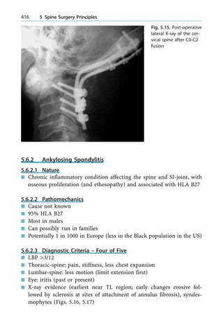 5.6.2 Ankylosing Spondylitis
5.6.2.1 Nature
n Chronic inflammatory condition affecting the spine and SI-joint, with
osseous proliferation (and ethesopathy) and associated with HLA B27
5.6.2.2 Pathomechanics
n Cause not known
n 95% HLA B27
n Most in males
n Can possibly run in families
n Potentially 1 in 1000 in Europe (less in the Black population in the US)
5.6.2.3 Diagnostic Criteria ± Four of Five
n LBP >3/12
n Thoracic-spine: pain, stiffness, less chest expansion
n Lumbar-spine: less motion (limit extension first)
n Eye: iritis (past or present)
n X-ray evidence (earliest near TL region; early changes erosive fol-
lowed by sclerosis at sites of attachment of annulus fibrosis), syndes-
mophytes (Figs. 5.16, 5.17)
416 5 Spine Surgery Principles
Fig. 5.15. Post-operative
lateral X-ray of the cer-
vical spine after C0-C2
fusion
 