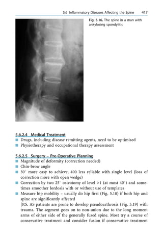 5.6.2.4 Medical Treatment
n Drugs, including disease remitting agents, need to be optimised
n Physiotherapy and occupational therapy assessment
5.6.2.5 Surgery ± Pre-Operative Planning
n Magnitude of deformity (correction needed)
n Chin-brow angle
n 308 more easy to achieve, 400 less reliable with single level (loss of
correction more with open wedge)
n Correction by two 258 osteotomy of level >1 (at most 408) and some-
times smoother lordosis with or without use of templates
n Measure hip mobility ± usually do hip first (Fig. 5.18) if both hip and
spine are significantly affected
[P.S. AS patients are prone to develop pseudoarthrosis (Fig. 5.19) with
trauma. The segment goes on to non-union due to the long moment
arms of either side of the generally fused spine. Most try a course of
conservative treatment and consider fusion if conservative treatment
a 5.6 Inflammatory Diseases Affecting the Spine 417
Fig. 5.16. The spine in a man with
ankylosing spondylitis
 