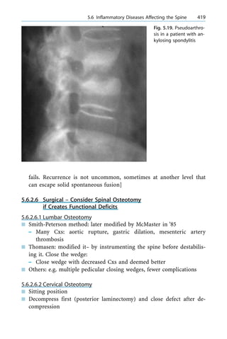 fails. Recurrence is not uncommon, sometimes at another level that
can escape solid spontaneous fusion]
5.6.2.6 Surgical ± Consider Spinal Osteotomy
if Creates Functional Deficits
5.6.2.6.1 Lumbar Osteotomy
n Smith-Peterson method: later modified by McMaster in '85
± Many Cxs: aortic rupture, gastric dilation, mesenteric artery
thrombosis
n Thomasen: modified it± by instrumenting the spine before destabilis-
ing it. Close the wedge:
± Close wedge with decreased Cxs and deemed better
n Others: e.g. multiple pedicular closing wedges, fewer complications
5.6.2.6.2 Cervical Osteotomy
n Sitting position
n Decompress first (posterior laminectomy) and close defect after de-
compression
a 5.6 Inflammatory Diseases Affecting the Spine 419
Fig. 5.19. Pseudoarthro-
sis in a patient with an-
kylosing spondylitis
 