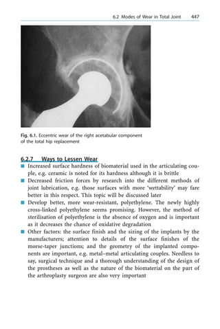 6.2.7 Ways to Lessen Wear
n Increased surface hardness of biomaterial used in the articulating cou-
ple, e.g. ceramic is noted for its hardness although it is brittle
n Decreased friction forces by research into the different methods of
joint lubrication, e.g. those surfaces with more `wettability' may fare
better in this respect. This topic will be discussed later
n Develop better, more wear-resistant, polyethylene. The newly highly
cross-linked polyethylene seems promising. However, the method of
sterilisation of polyethylene is the absence of oxygen and is important
as it decreases the chance of oxidative degradation
n Other factors: the surface finish and the sizing of the implants by the
manufacturers; attention to details of the surface finishes of the
morse-taper junctions; and the geometry of the implanted compo-
nents are important, e.g. metal±metal articulating couples. Needless to
say, surgical technique and a thorough understanding of the design of
the prostheses as well as the nature of the biomaterial on the part of
the arthroplasty surgeon are also very important
a 6.2 Modes of Wear in Total Joint 447
Fig. 6.1. Eccentric wear of the right acetabular component
of the total hip replacement
 