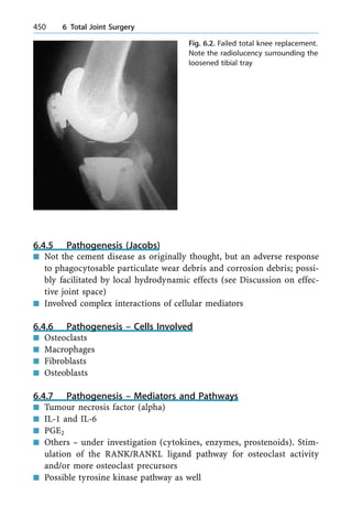 6.4.5 Pathogenesis (Jacobs)
n Not the cement disease as originally thought, but an adverse response
to phagocytosable particulate wear debris and corrosion debris; possi-
bly facilitated by local hydrodynamic effects (see Discussion on effec-
tive joint space)
n Involved complex interactions of cellular mediators
6.4.6 Pathogenesis ± Cells Involved
n Osteoclasts
n Macrophages
n Fibroblasts
n Osteoblasts
6.4.7 Pathogenesis ± Mediators and Pathways
n Tumour necrosis factor (alpha)
n IL-1 and IL-6
n PGE2
n Others ± under investigation (cytokines, enzymes, prostenoids). Stim-
ulation of the RANK/RANKL ligand pathway for osteoclast activity
and/or more osteoclast precursors
n Possible tyrosine kinase pathway as well
450 6 Total Joint Surgery
Fig. 6.2. Failed total knee replacement.
Note the radiolucency surrounding the
loosened tibial tray
 