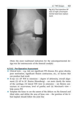(Note: the most traditional indication for the unicompartmental de-
sign was for osteonecrosis of the femoral condyle)
6.7.9.3 Pre-Operative Assessment
n Clinical tests ± e.g. rule out significant PFJ disease, RA, gross obesity,
poor motivation, significant flexion contracture, etc., or factors that
can produce bad result
n X-ray: (1) AP WB in extension ± degree of deformity, overall align-
ment; (2) AP in 208 flexion (Rosenberg) ± see more clearly the status
of the cartilage; (3) lateral WB view in extension ± see flexion con-
tracture or recurvatum, level of patella; and (4) Merchant's view ±
help assess PFJ
n Template the knee: to see the extent of the defects on the femoral and
tibial sides, and define the area of bone cuts ± the position of the ti-
bial implant should follow the joint line
a 6.7 TKR Designs 469
Fig. 6.3. Post-operative AP
view of right unicompart-
mental total knee replace-
ment
 