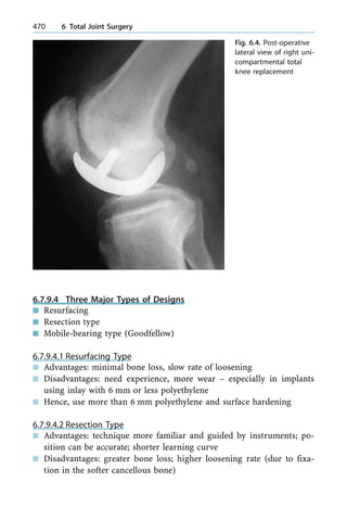 6.7.9.4 Three Major Types of Designs
n Resurfacing
n Resection type
n Mobile-bearing type (Goodfellow)
6.7.9.4.1 Resurfacing Type
n Advantages: minimal bone loss, slow rate of loosening
n Disadvantages: need experience, more wear ± especially in implants
using inlay with 6 mm or less polyethylene
n Hence, use more than 6 mm polyethylene and surface hardening
6.7.9.4.2 Resection Type
n Advantages: technique more familiar and guided by instruments; po-
sition can be accurate; shorter learning curve
n Disadvantages: greater bone loss; higher loosening rate (due to fixa-
tion in the softer cancellous bone)
470 6 Total Joint Surgery
Fig. 6.4. Post-operative
lateral view of right uni-
compartmental total
knee replacement
 