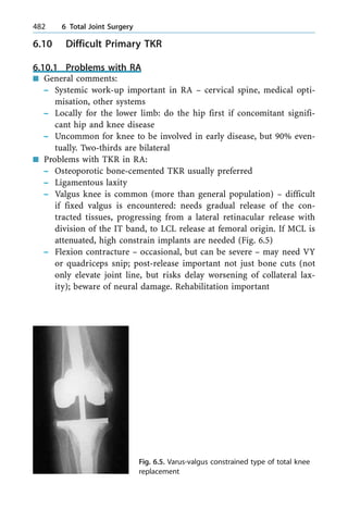 6.10 Difficult Primary TKR
6.10.1 Problems with RA
n General comments:
± Systemic work-up important in RA ± cervical spine, medical opti-
misation, other systems
± Locally for the lower limb: do the hip first if concomitant signifi-
cant hip and knee disease
± Uncommon for knee to be involved in early disease, but 90% even-
tually. Two-thirds are bilateral
n Problems with TKR in RA:
± Osteoporotic bone-cemented TKR usually preferred
± Ligamentous laxity
± Valgus knee is common (more than general population) ± difficult
if fixed valgus is encountered: needs gradual release of the con-
tracted tissues, progressing from a lateral retinacular release with
division of the IT band, to LCL release at femoral origin. If MCL is
attenuated, high constrain implants are needed (Fig. 6.5)
± Flexion contracture ± occasional, but can be severe ± may need VY
or quadriceps snip; post-release important not just bone cuts (not
only elevate joint line, but risks delay worsening of collateral lax-
ity); beware of neural damage. Rehabilitation important
482 6 Total Joint Surgery
Fig. 6.5. Varus-valgus constrained type of total knee
replacement
 