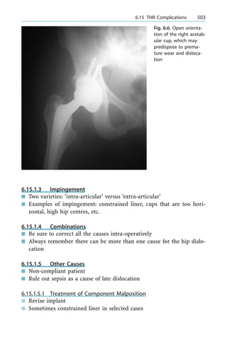 6.15.1.3 Impingement
n Two varieties: `intra-articular' versus `extra-articular'
n Examples of impingement: constrained liner, cups that are too hori-
zontal, high hip centres, etc.
6.15.1.4 Combinations
n Be sure to correct all the causes intra-operatively
n Always remember there can be more than one cause for the hip dislo-
cation
6.15.1.5 Other Causes
n Non-compliant patient
n Rule out sepsis as a cause of late dislocation
6.15.1.5.1 Treatment of Component Malposition
n Revise implant
n Sometimes constrained liner in selected cases
a 6.15 THR Complications 503
Fig. 6.6. Open orienta-
tion of the right acetab-
ular cup, which may
predispose to prema-
ture wear and disloca-
tion
 